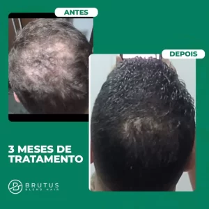 brutus-blend-hair-3-meses.jpeg
